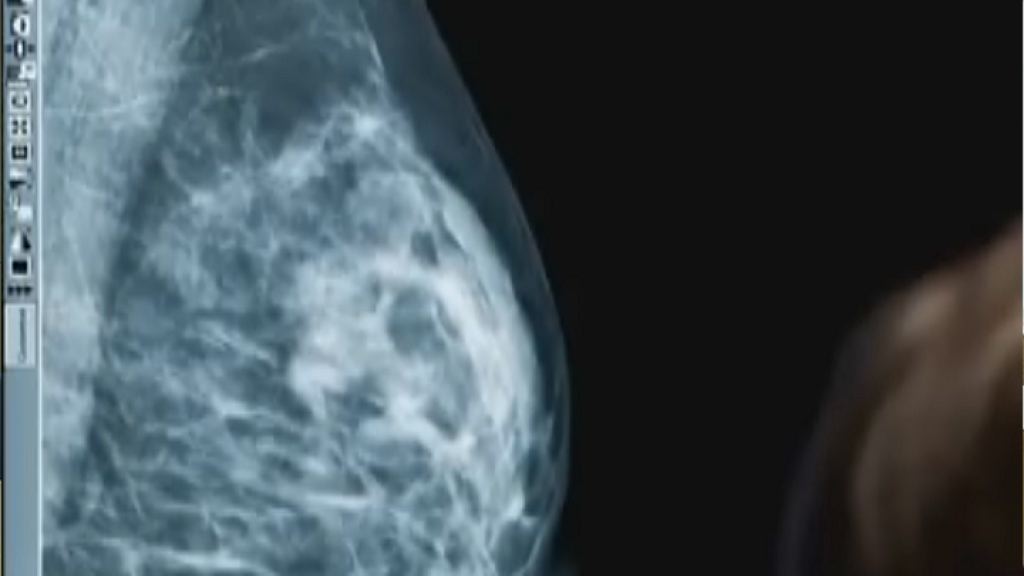 Mamograf