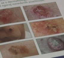 Teden boja proti melanomu